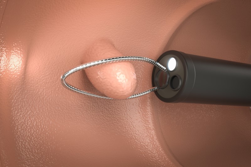 大腸ポリープとはどのようなもの？