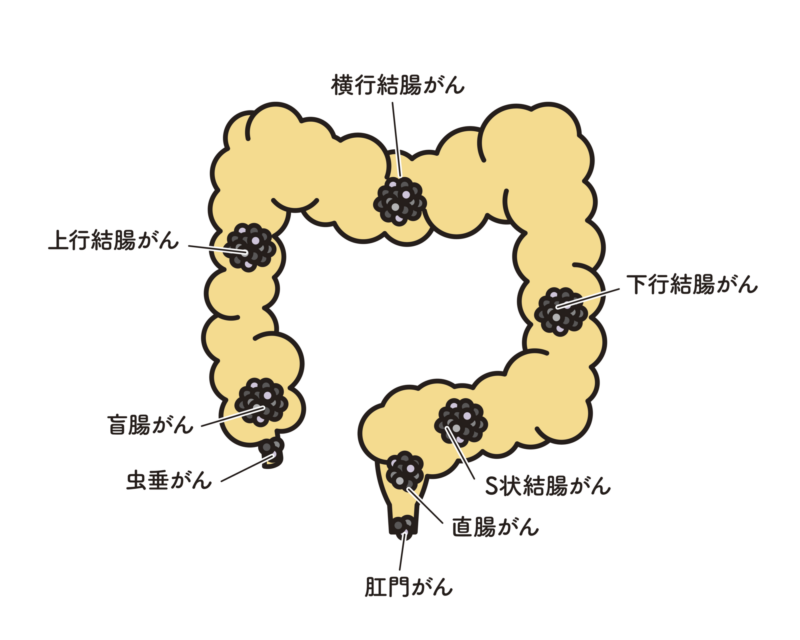 大腸がん