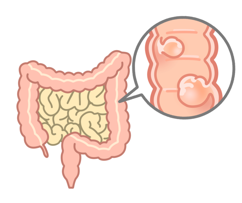 大腸ポリープ
