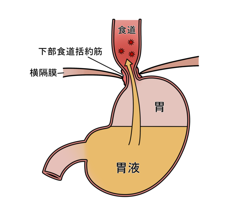 逆流性食道炎